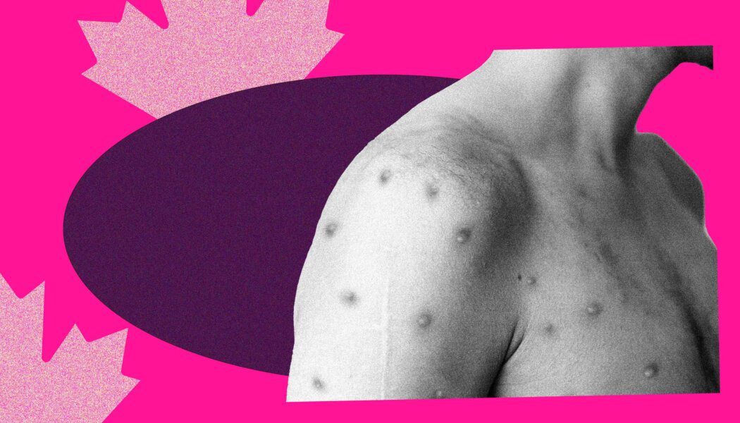 You can get Mpox even if you’re vaccinated—it happened to me